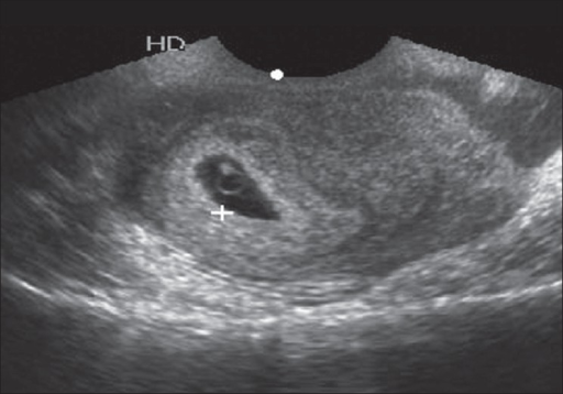 Single intrauterine gestational sac with yolk sac on 20 | Open-i