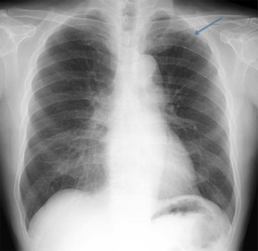lung apex dead space