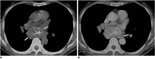 Follicular dendritic cell sarcoma in mediastinum in 47- | Open-i