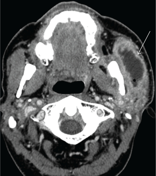 Left Facial Abscess A Axial Contrast Enhanced Ct So Open I