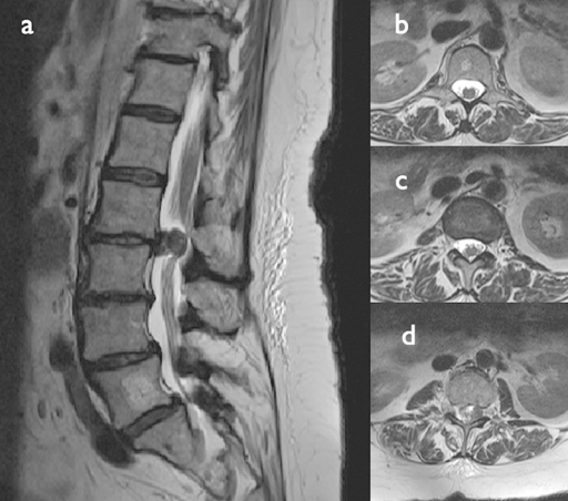 Preintervention magnetic resonance imaging (MRI). (a) S | Open-i