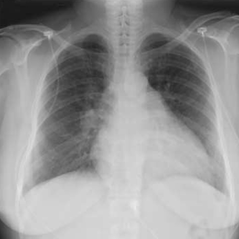 Chest radiography shows moderate cardiomegaly without p | Open-i