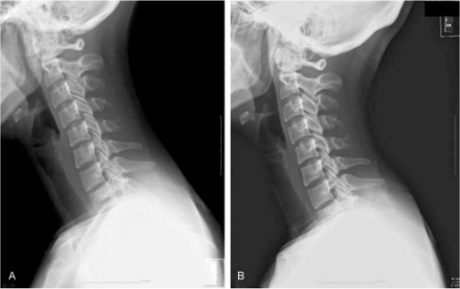 Initial and follow up C-spine lateral view. Initial C-s | Open-i