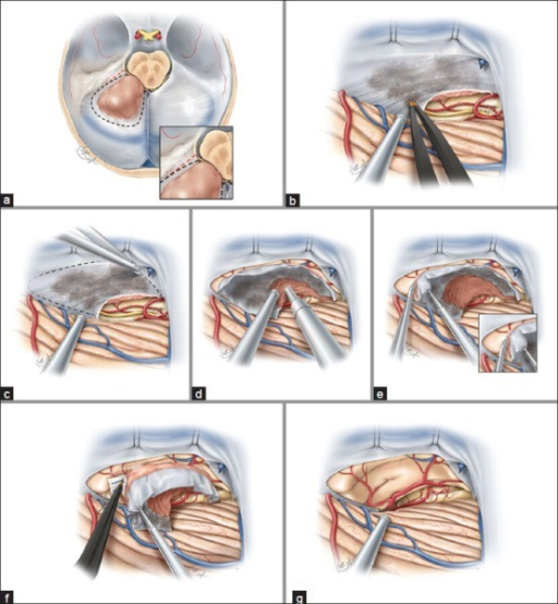 Medial tentorial meningiomas protrude along the tentori | Open-i