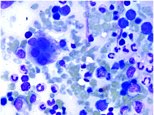 Bone marrow aspirate smear demonstrating hypercellular | Open-i