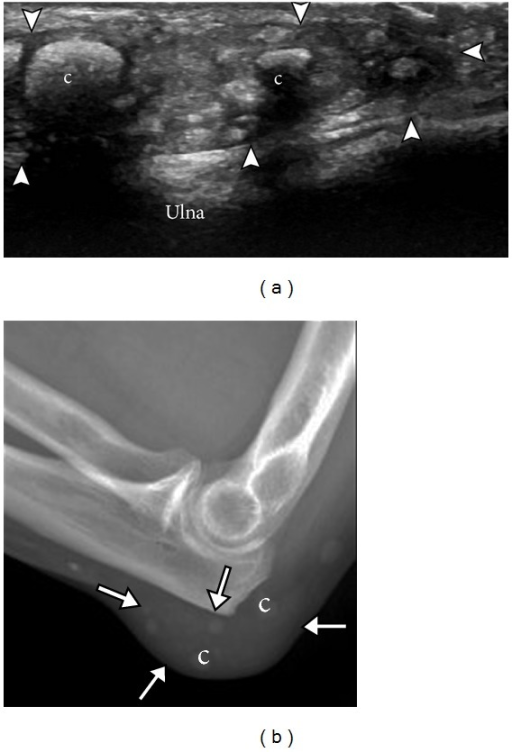 Olecranon Bursa Ultrasound A And Radiograph B Demo Open I