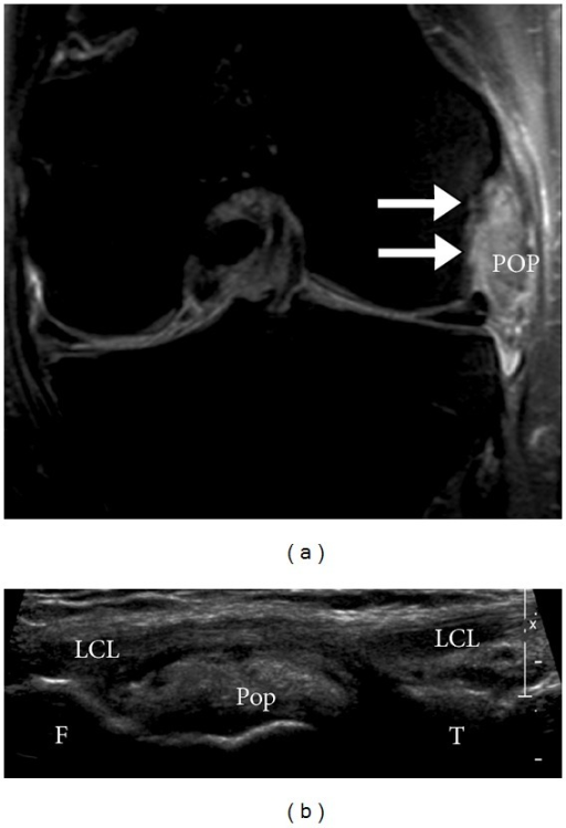 Popliteus Tendon Mri