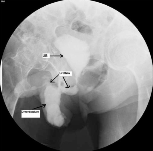 retrograde urethrogram