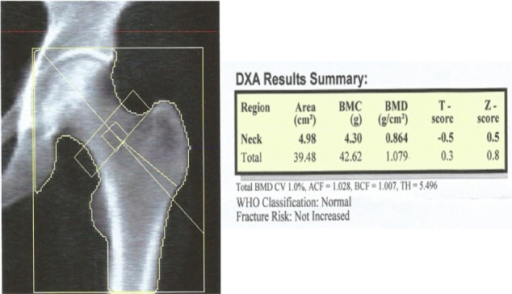 Normal DEXA Scan Of A Patient Open i