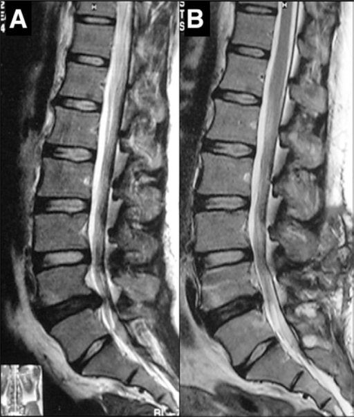 ct scan for sciatica