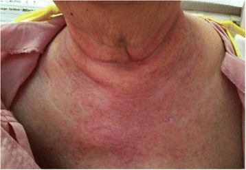 rash chest Facial pain and