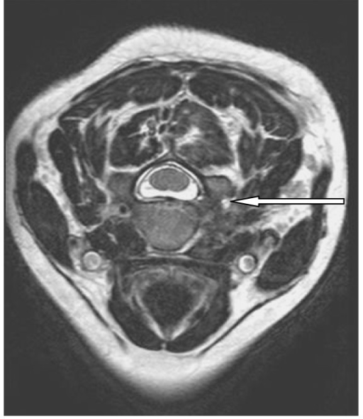 Mri Of The Cervical Spine T2 Weighted Image Shows High Open I