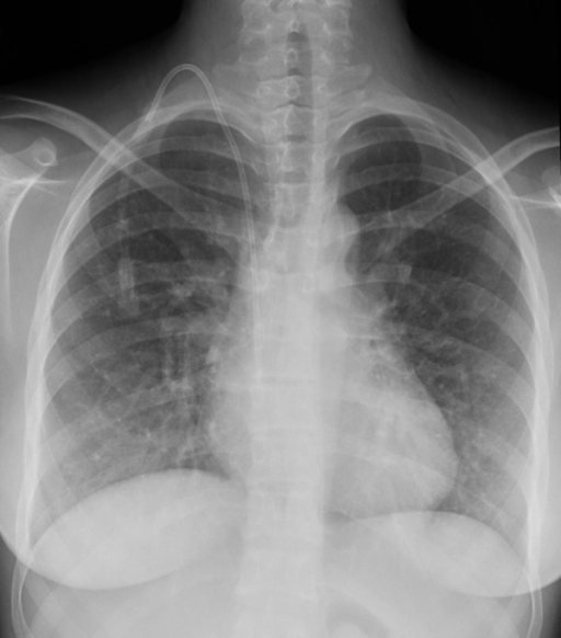 Chest antero-posterior X-ray showing a normal heart siz | Open-i