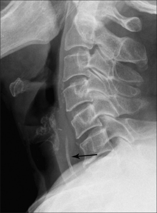 Lateral radiograph of the neck of an elderly patient sh | Open-i