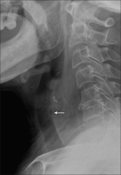 Lateral radiograph of a patient shows widening of the p | Open-i