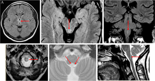 Typical Brain Mri Lesions In Neuromyelitis Optica Repr Open I