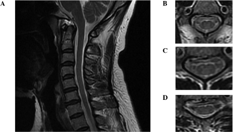 T2weighted Sagittal Mri Showing Spinal Cord Conus