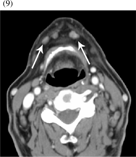 submental lymph nodes submental lymph nodes