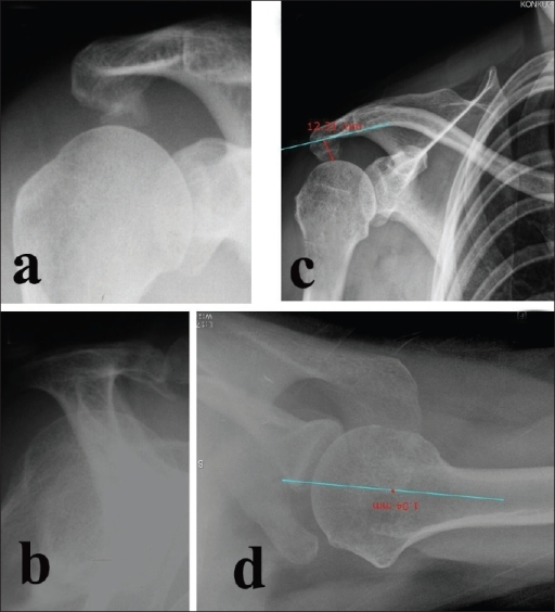 Showing (a) acromial spur in 30° caudal tilt view X-ra | Open-i