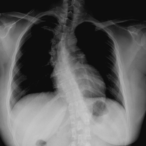 Chest X-ray show fixed scoliotic deformity. The major s | Open-i