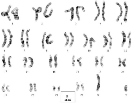 High Resolution G-band Chromosomes Karyotype Showing Th 