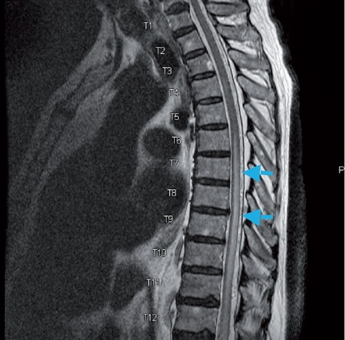 sagittal-t2-weighted-image-of-the-thoracic-spine-demons-open-i