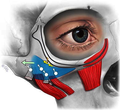 Location Of The Fixation Sutures In The Prezygomatic Sp 