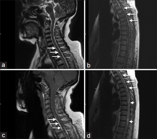 (a) Cervical spine T1-weighted MRI, (b) cervical spine | Open-i