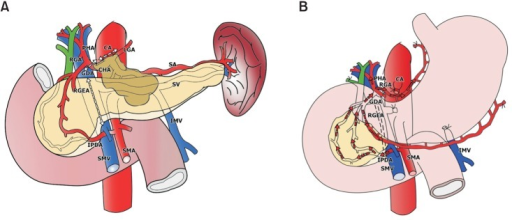 Schematic Showing Distal Pancreatectomy With En Bloc Ce Open I