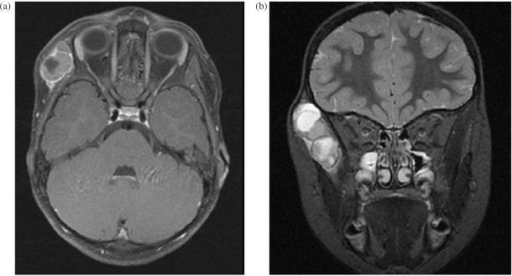 (a) Axial T1 weighted MRI of a right temporalis muscle | Open-i