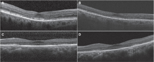 Spectral domain optical coherence tomography (SD OCT) i | Open-i