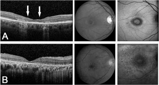 Spectral domain optical coherence tomography (SD OCT) i | Open-i