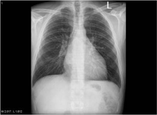 CXR with splaying of the carina. | Open-i