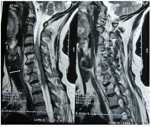 MRI of cervicodorsal spine showing altered marrow signa | Open-i