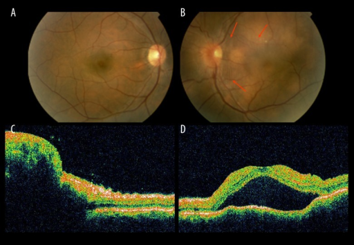 A Right Eye Fundus Examination Without Any Remarkable A Right Eye Fundus Examination Without Any Remarkable