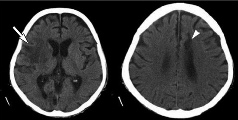 Acute cerebral infarction is seen in the right fronto-t | Open-i