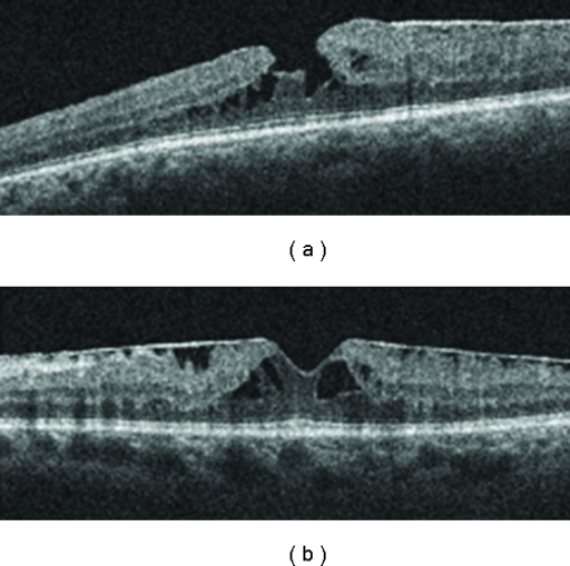 Optical Coherence Tomography Of A Lamellar Macular Hole And B An Optical Coherence Tomography Of A Lamellar Macular Hole And B An