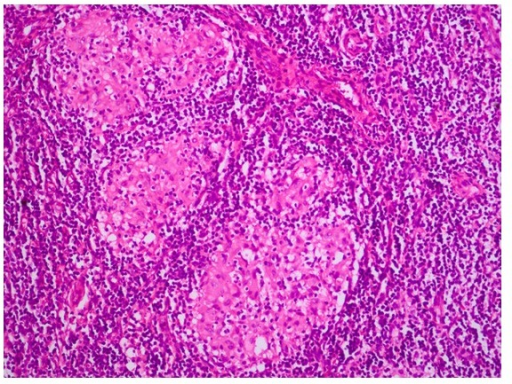 Photomicrograph Of Lymph Node Biopsy Specimen Showing C Open I