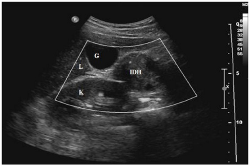 Ultrasound of the abdomen demonstrates a well-defined h | Open-i