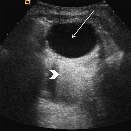 Simple Ovarian Cyst Longitudinal Image Through The Pel Open I