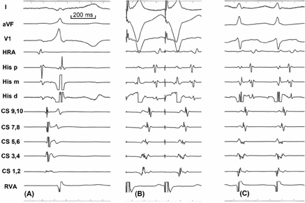 Surface lead electrocardiograms and intracardiac electr | Open-i