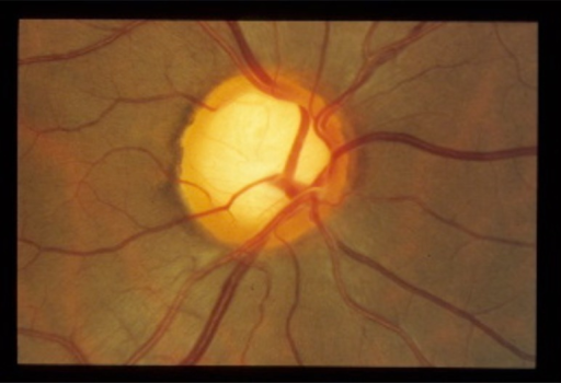 Normal Large Optic Nerve With Corresponding Physiologic Open i