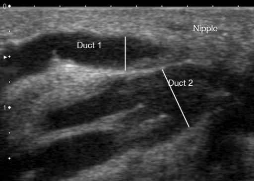 Ultrasound Image Of A Milk Ducts In The Human Lactating Open I