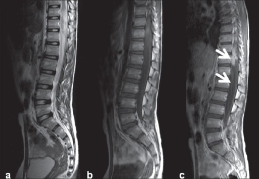 Intramedullary tuberculoma with arachnoiditis. Heteroge | Open-i