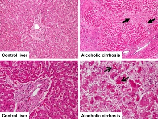 Alcoholic Liver Cirrhosis In A 56 Year Old Female Patie Open I