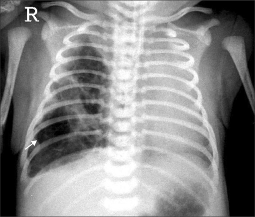 Chest X Ray Of The Neonate On First Day Of Admission Sh Open I