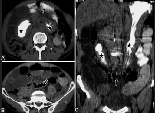 CT scan axial and oblique coronal images show elongated | Open-i