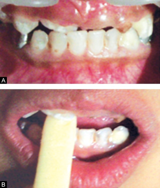 Tongue Blade Therapy For Developing Anterior Crossbite Open I