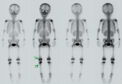 Whole Body Bone Scan Using Technetium 99m Shows Increas Open I   PMC3012272 Kjped 53 931 G002 