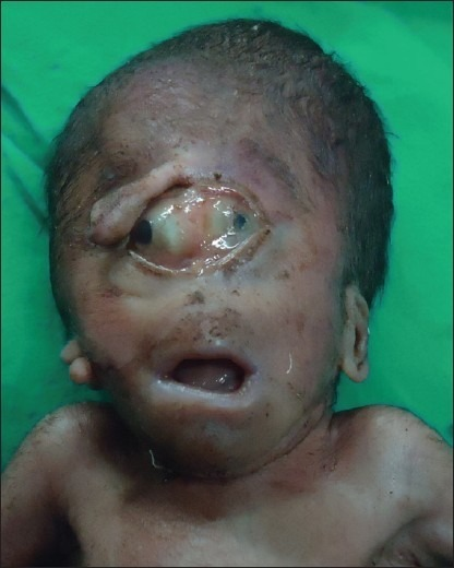 Clinical photograph showing ethmocephaly with ocular hy | Open-i